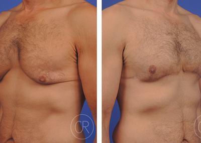 Photo du torse nu d un homme avant/apres gynecomastie | Dr Christophe Reinbold Lyon