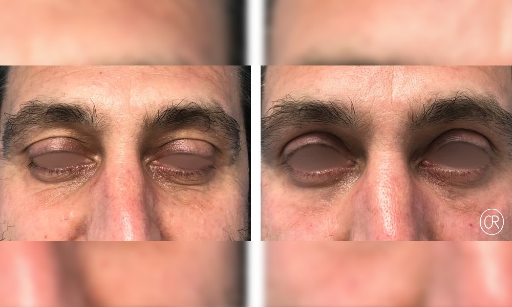 Image des yeux d un homme avant/apres injection dacide hyaluronique | Dr Christophe Reinbold Lyon