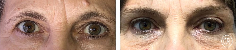 Photo rapprochee sur les yeux d une femme d age moyen avant/apres blepharoplastie | Dr Christophe Reinbold Lyon