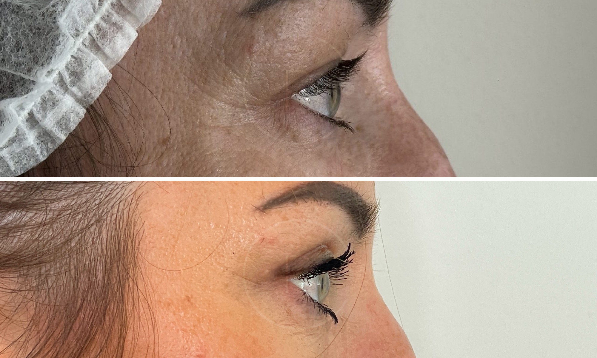 Photo rapprochee sur les yeux d une femme de profile droit avant/apres blepharoplastie | Dr Christophe Reinbold Lyon