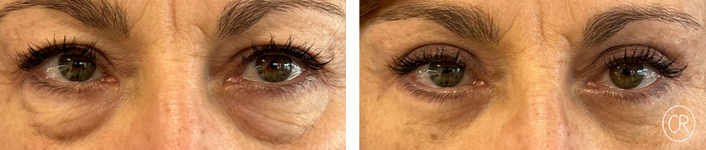 Vue rapprochee sur les yeux d une femme agee avant/apres blepharoplastie | Dr Christophe Reinbold Lyon