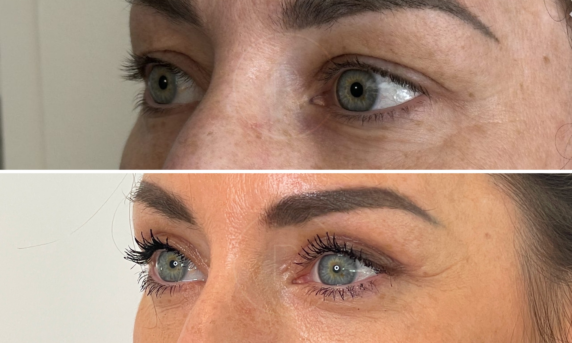 Photo rapprochee sur les yeux d une jeune femme profile gauche avant/apres blepharoplastie | Dr Christophe Reinbold Lyon