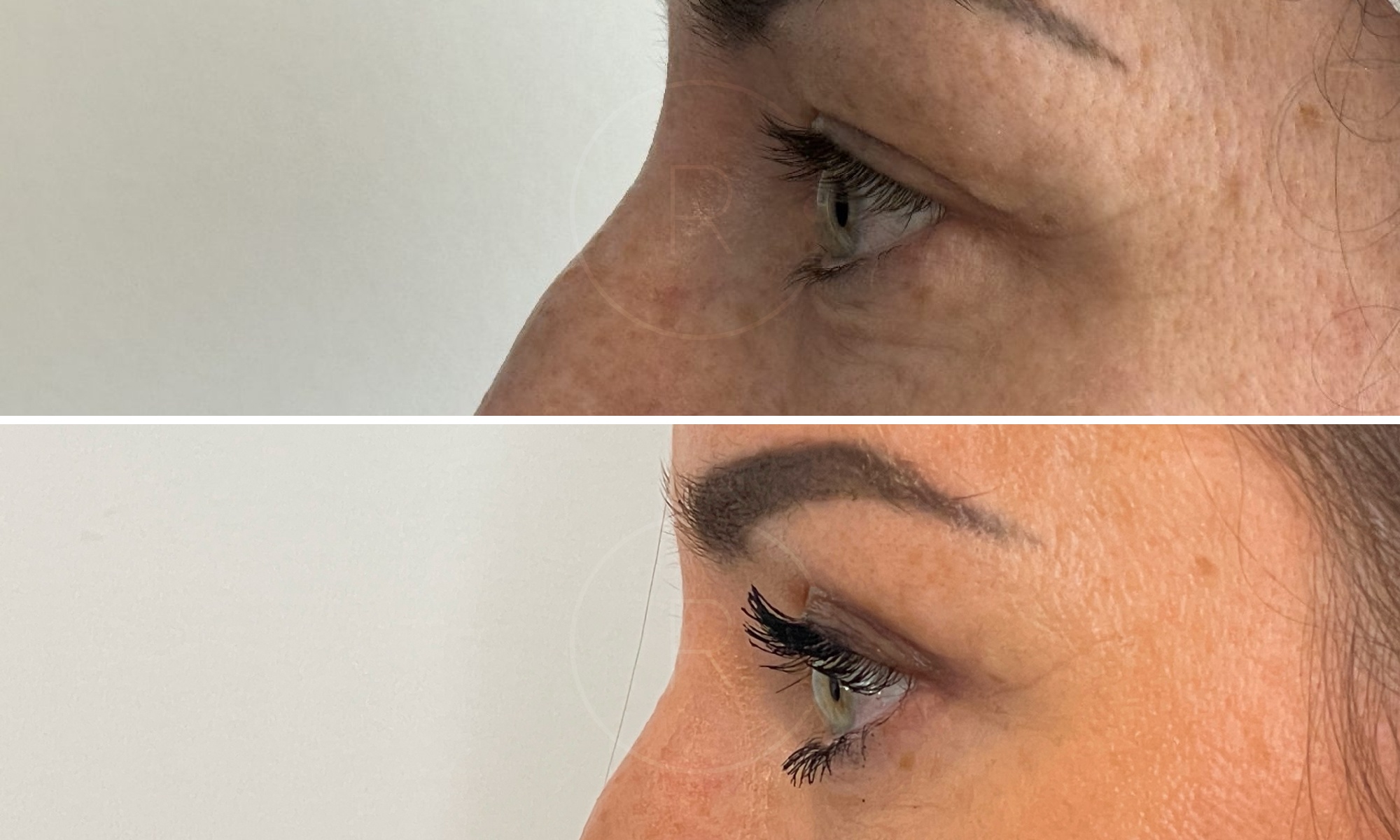 Vue rapprochee sur l oeil d une femme de profile gauche Blepharoplastie | Dr Christophe Reinbold Lyon