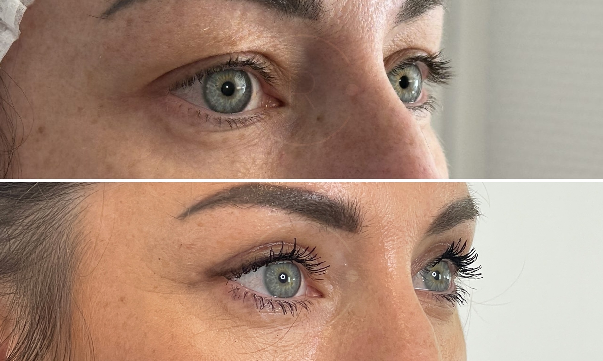 Photo rapprochee sur les yeux d une femme d age moyen de profile droit avant/apres blepharoplastie | Dr Christophe Reinbold Lyon