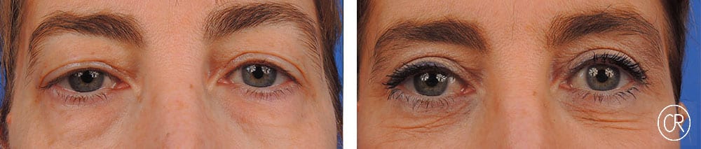 Vue rapprochee sur les yeux d une femme d age moyen avant/apres blepharoplastie | Dr Christophe Reinbold Lyon