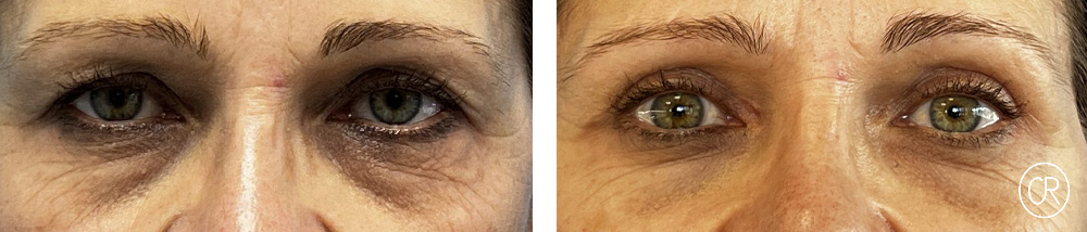 Photo rapprochee sur les yeux d une femme d age moyen avant/apres blepharoplastie | Dr Christophe Reinbold Lyon