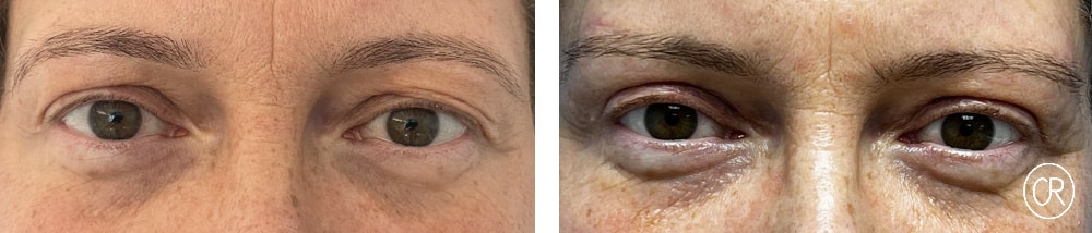 Vue rapprochee sur les yeux d une femme d age moyen avant/apres blepharoplastie | Dr Christophe Reinbold Lyon