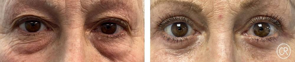 Photo rapprochee sur les yeux d une femme agee avant/apres blepharoplastie | Dr Christophe Reinbold Lyon