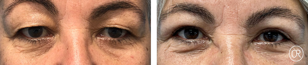 Vue rapprochee sur les yeux d une femme d age moyen avant/apres blepharoplastie | Dr Christophe Reinbold Lyon