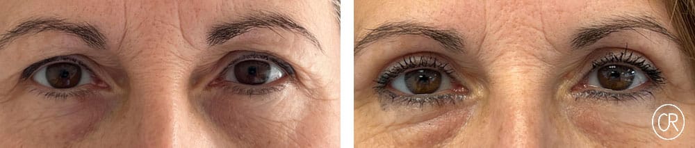 Photo rapprochee sur les yeux d une femme d age moyen avant/apres blepharoplastie | Dr Christophe Reinbold Lyon