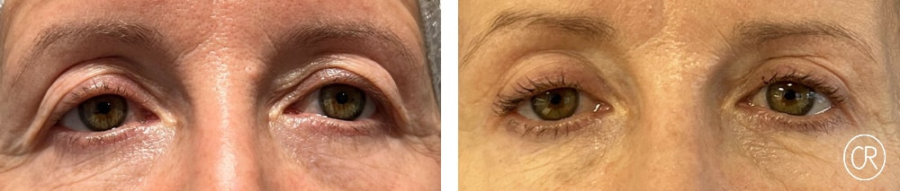 Vue rapprochee sur les yeux d une femme agee avant/apres blepharoplastie | Dr Christophe Reinbold Lyon