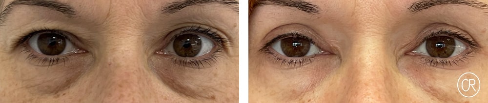 Photo rapprochee sur les yeux d une femme avant/apres blepharoplastie | Dr Christophe Reinbold Lyon