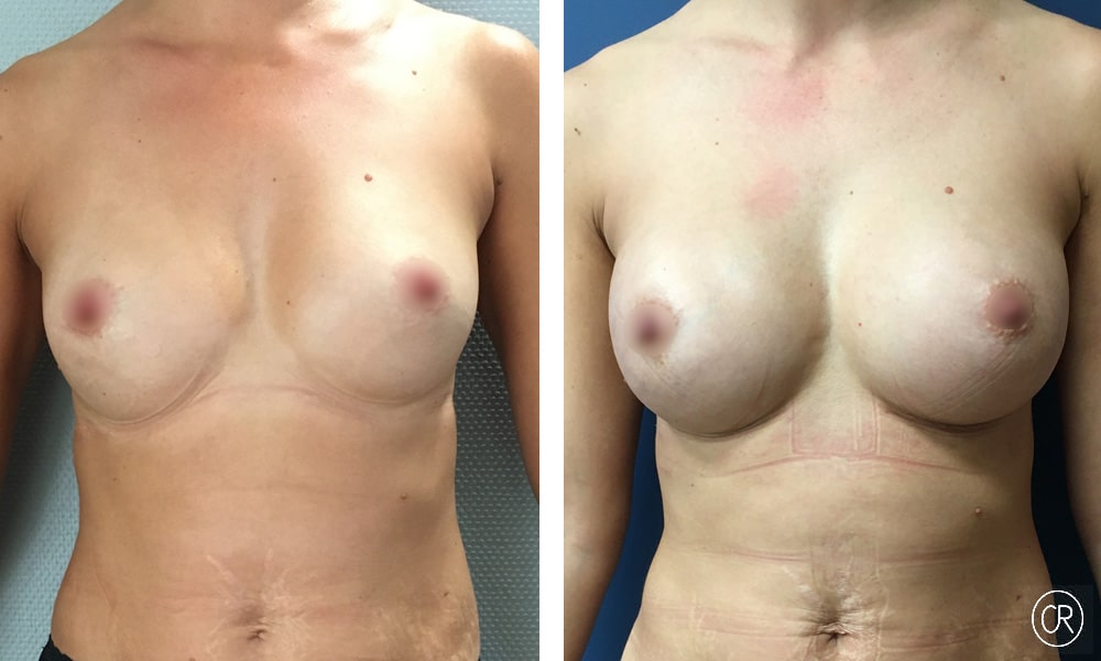 Photo de poitrine et ventre d une jeune femme avant/apres lipofilling des seins | Dr Christophe Reinbold Lyon