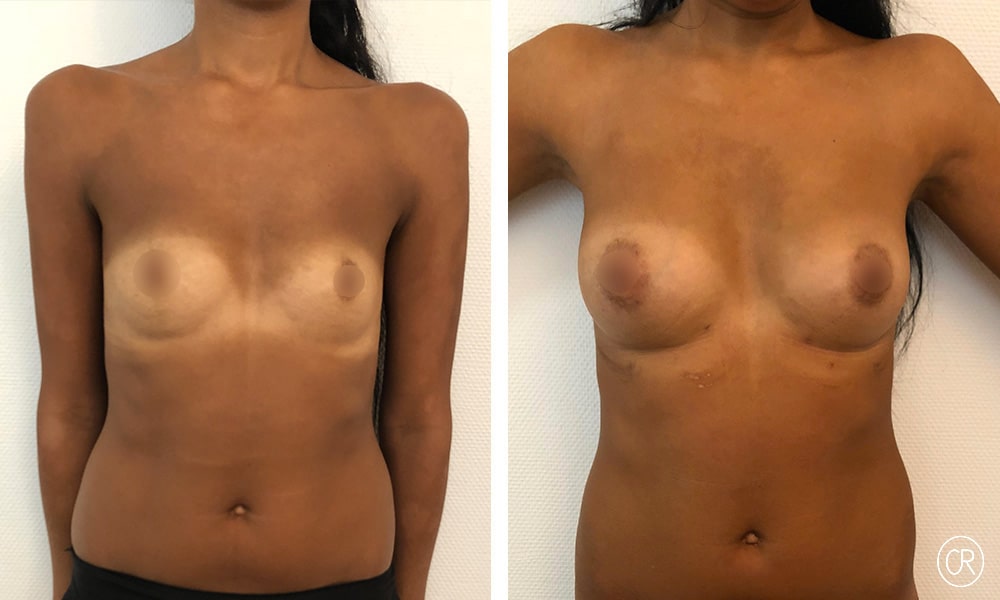 Photo de poitrine et ventre d une jeune femme avant/apres lipofilling des seins | Dr Christophe Reinbold Lyon