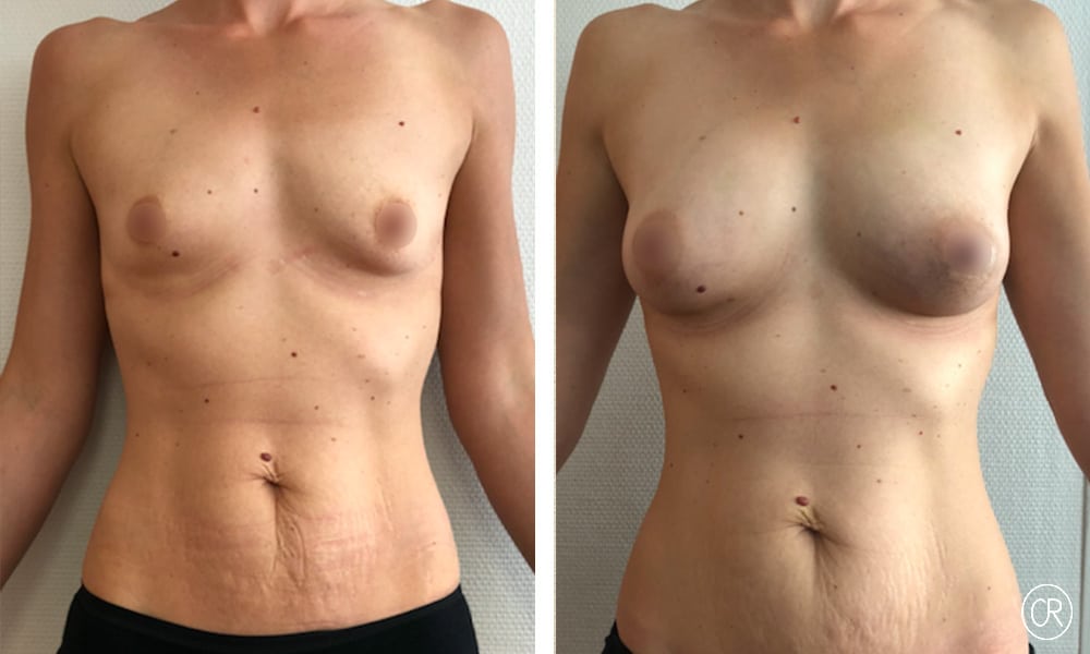 Poitrine et ventre d une jeune femme avant/apres lipofilling des seins | Dr Christophe Reinbold Lyon