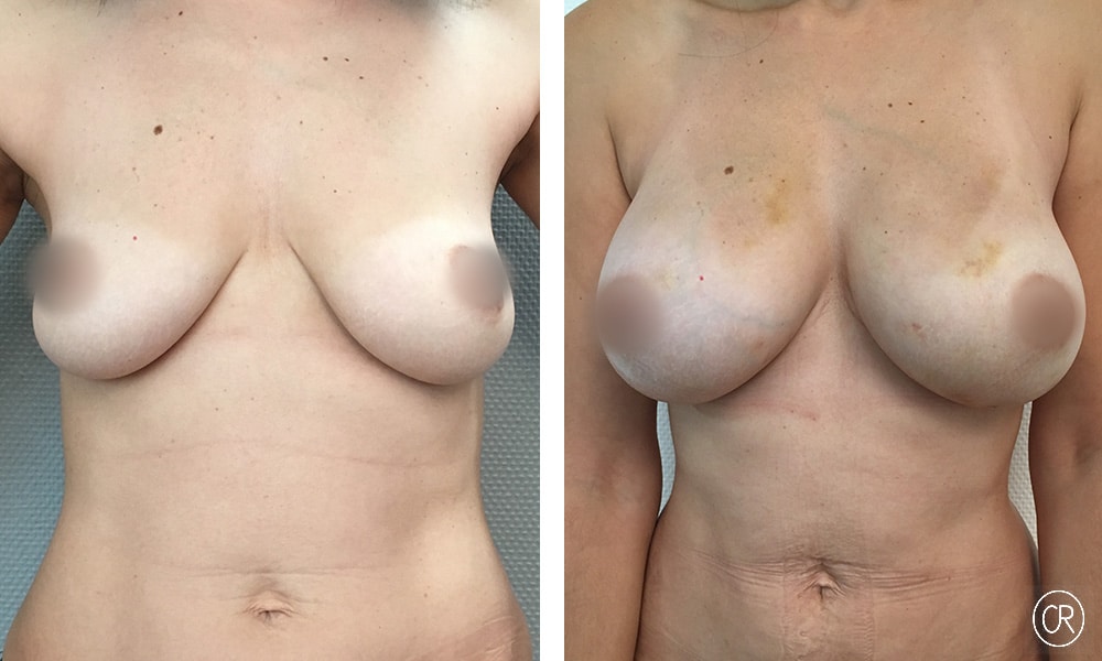 Photo de poitrine et ventre d une jeune femme avant/apres lipofilling des seins | Dr Christophe Reinbold Lyon