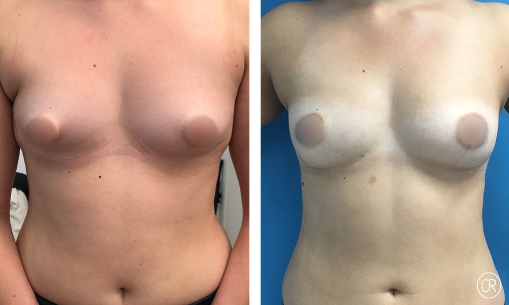 Poitrine et ventre d une jeune femme avant/apres lipofilling des seins | Dr Christophe Reinbold Lyon